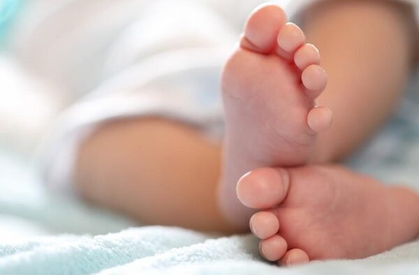 ilustrasi bayi achondroplasia 1 169